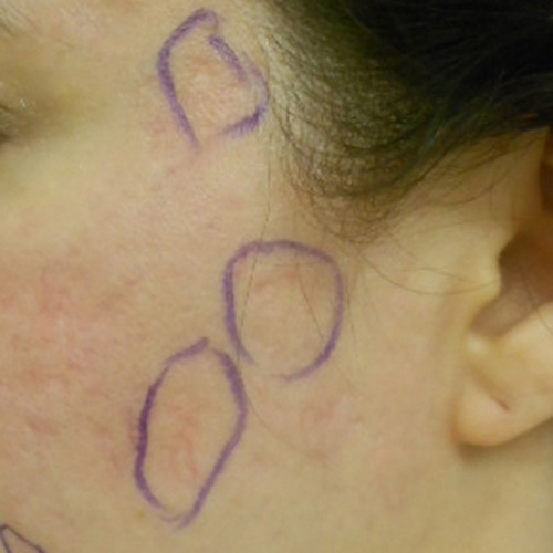 Acne scars after subcision