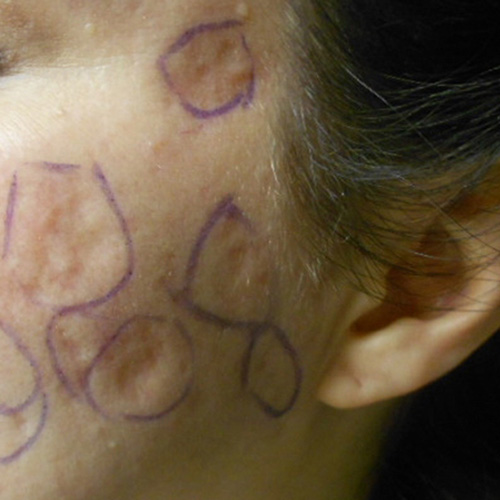 Acne scars before subcision