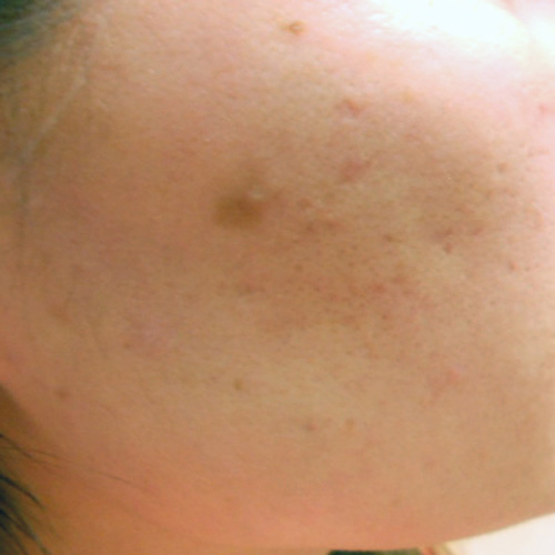 Acne scars before TCA-CROSS procedure