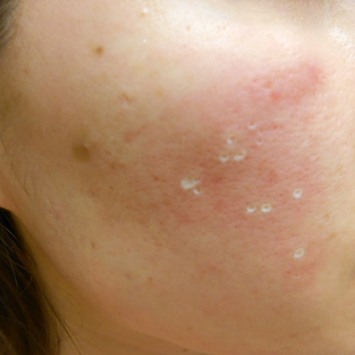 Acne scars immediately after TCA-CROSS procedure