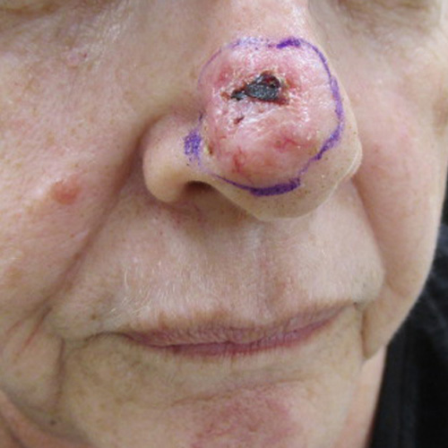 Basal cell carcinoma on the nose