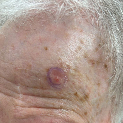 Basal cell carcinoma on the forehead