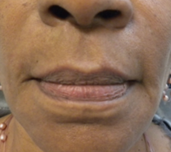Photo of smile lines after Radiesse filler