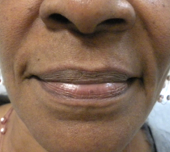 Photo of smile lines before Radiesse filler