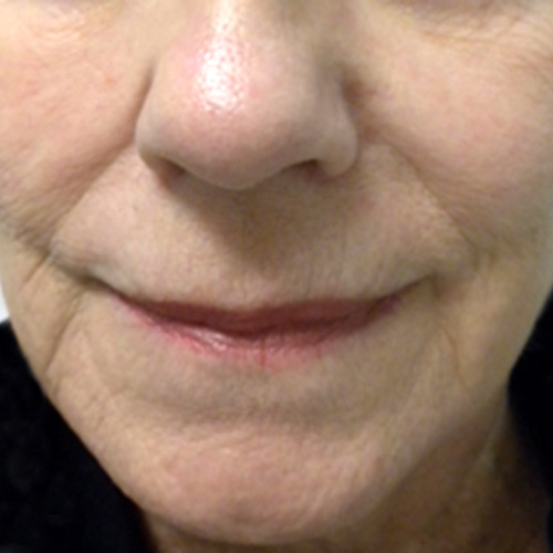 Photo of face after fractional laser resurfacing
