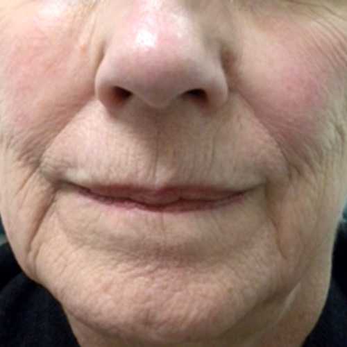 Photo of face before fractional laser resurfacing