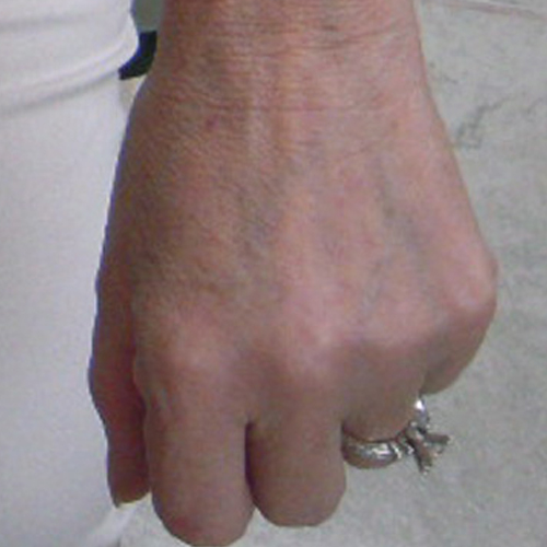 Photo of hand after IPL rejuvenation