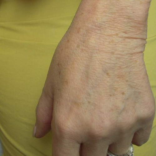 Photo of hand before IPL rejuvenation