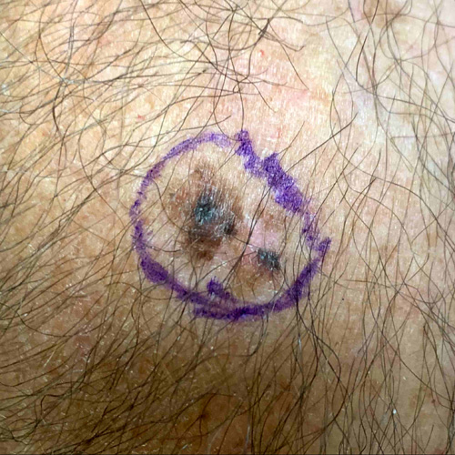 Melanoma on the trunk