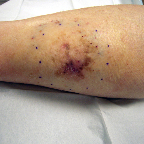 Melanoma on the leg