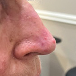 Basal cell carcinoma on the nose, healed after Mohs surgery