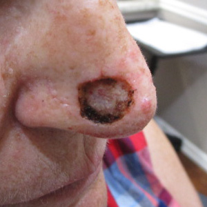 Defect after Mohs surgery for basal cell carcinoma