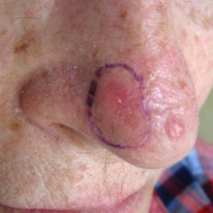 Basal cell carcinoma on the nose