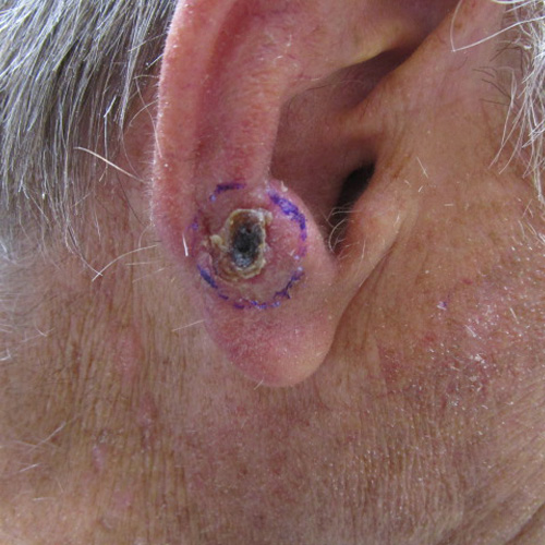 Squamous cell carcinoma on the ear
