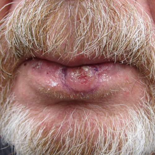 Squamous cell carcinoma on the lip