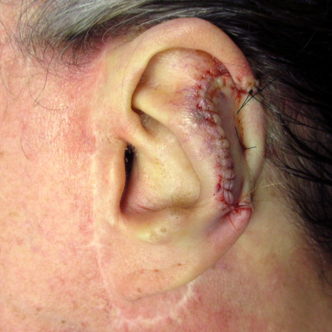 Example of flap repair on the ear
