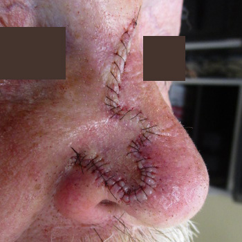 Example of flap repair on the nose