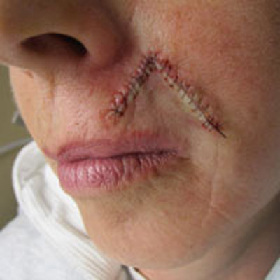 Example of flap repair on the face