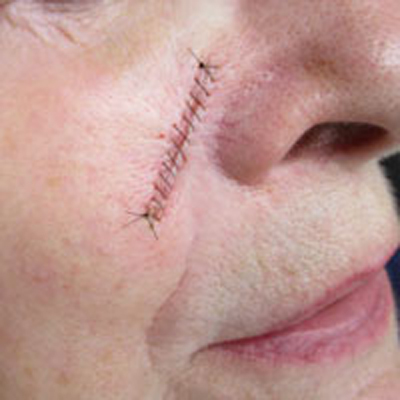 Linear repair on the face