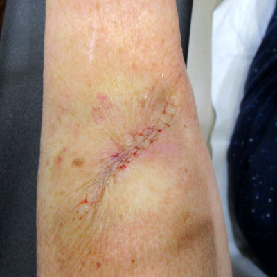 Linear repair on the arm