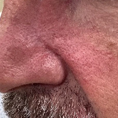 Photo of perinasal capillaries immediately after KTP laser