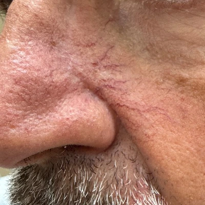 Photo of perinasal capillaries before KTP laser