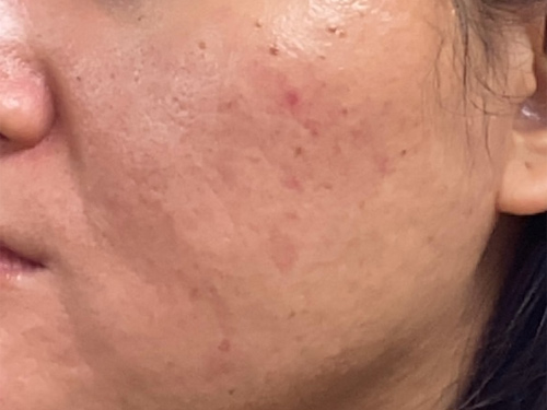 Five weeks after one subcision treatment