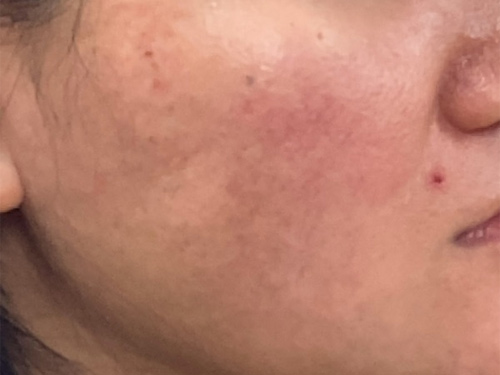 Photo of rolling scars after subcision