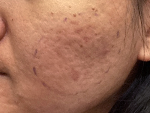 Rolling acne scars before subcision