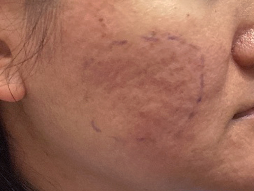 Photo of rolling scars before subcision