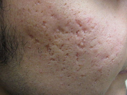 Icepick scars