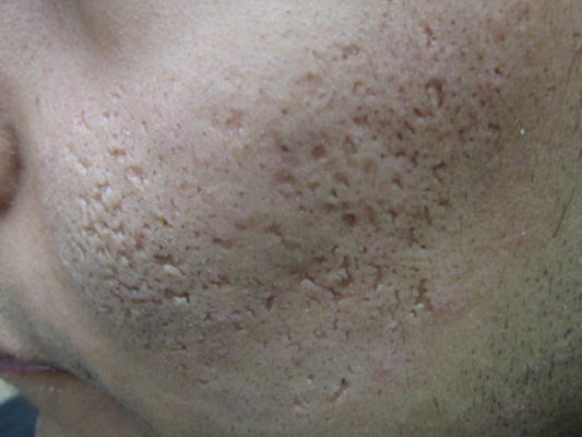 Icepick acne scars