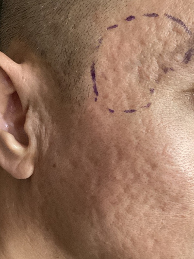 Rolling acne scars